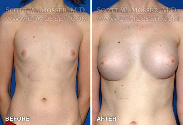 Breast Augmentation Transsexual 43