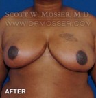 Breast Reduction Patient