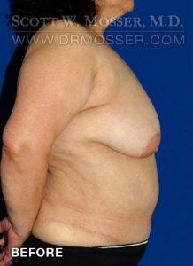 Breast Reduction Patient 54296 Before Photo # 5
