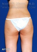Liposuction - Abdomen & Flanks Patient 82898 After Photo Thumbnail # 4