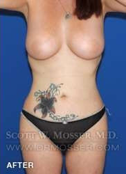 Liposuction - Abdomen & Flanks Patient 81638 After Photo # 2