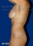Abdominoplasty Patient 54737 After Photo Thumbnail # 8