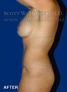 Abdominoplasty Patient 54737 After Photo # 8