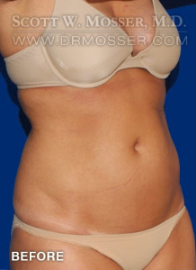 Liposuction - Abdomen & Flanks Patient 83778 Before Photo # 3