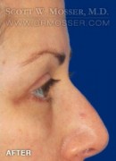 Brow Lift Patient 82649 After Photo Thumbnail # 4