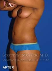 Liposuction - Abdomen & Flanks Patient 11942 After Photo # 6