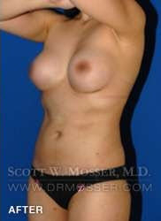 Liposuction - Abdomen & Flanks Patient 58519 After Photo # 6