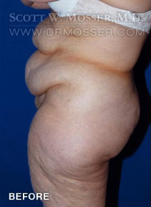 Abdominoplasty Patient 61872 Before Photo # 3
