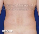 Liposuction - Abdomen & Flanks Patient 62116 Before Photo Thumbnail # 3