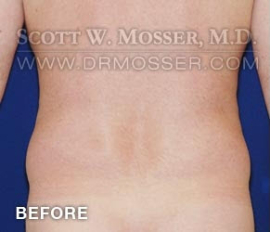 Liposuction - Abdomen & Flanks Patient 62116 Before Photo # 3