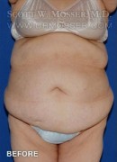 Abdominoplasty Patient 72192 Before Photo Thumbnail # 1