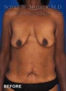 Breast Lift With Implants Patient 11670 Before Photo Thumbnail # 1