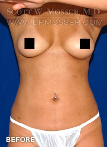 Liposuction - Abdomen & Flanks Patient 53811 Before Photo # 1