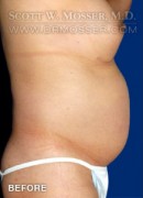 Liposuction - Abdomen & Flanks Patient 68884 Before Photo Thumbnail # 5