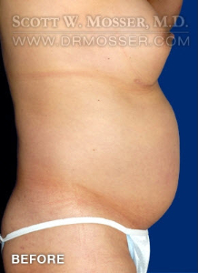 Liposuction - Abdomen & Flanks Patient 68884 Before Photo # 5