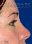 Upper Blepharoplasty Patient 79210 Before Photo Thumbnail # 5