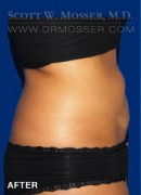 Liposuction - Abdomen & Flanks Patient 95887 After Photo Thumbnail # 6
