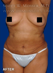 Liposuction - Abdomen & Flanks Patient 39968 After Photo # 2
