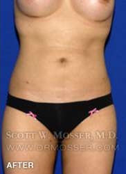 Liposuction - Abdomen & Flanks Patient 58519 After Photo # 2