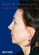 Chin Implant Patient 16572 Before Photo Thumbnail # 5