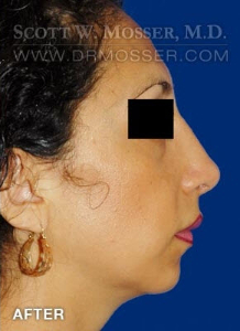 Rhinoplasty Patient 13734 After Photo # 4