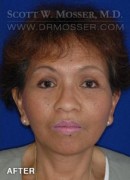 Chin Implant Patient 42601 After Photo Thumbnail # 2