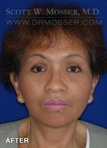 Chin Implant Patient 42601 After Photo # 2