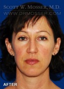 Upper Blepharoplasty Patient 81608 After Photo Thumbnail # 2