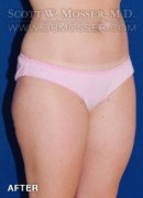 Liposuction - Thighs Patient 42034 After Photo Thumbnail # 4