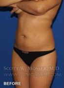 Liposuction - Abdomen & Flanks Patient 33709 Before Photo Thumbnail # 5