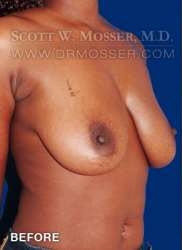 Breast Lift Without Implants Patient 95927 Before Photo # 3