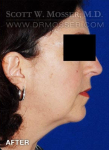 Chin Implant Patient 26401 After Photo # 2