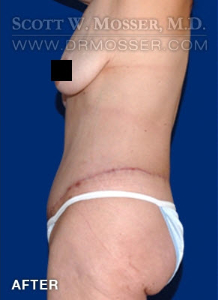 Lower Body Lift Patient 68424 After Photo # 4