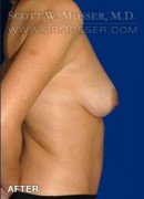 Breast Implant Removal Patient 99928 After Photo Thumbnail # 4
