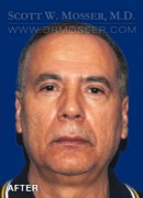 Upper Blepharoplasty Patient 77408 After Photo Thumbnail # 2