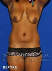 Liposuction - Abdomen & Flanks Patient 11942 Before Photo # 1