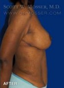 Breast Lift With Implants Patient 11670 After Photo Thumbnail # 4