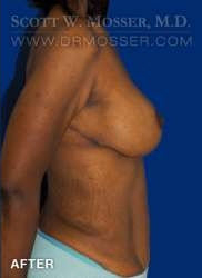 Breast Lift With Implants Patient 11670 After Photo # 4