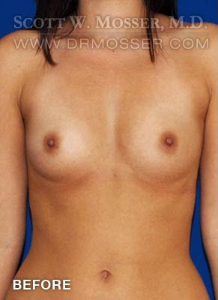 Breast Augmentation Patient 24873 Before Photo # 1