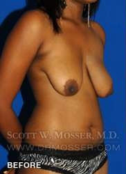 Breast Lift Without Implants Patient 55667 Before Photo # 3