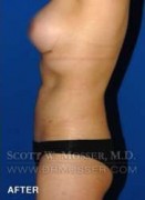Liposuction - Abdomen & Flanks Patient 58519 After Photo Thumbnail # 10