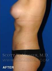 Liposuction - Abdomen & Flanks Patient 58519 After Photo # 10