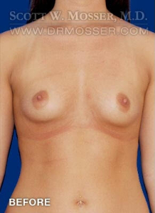 Breast Augmentation Patient 36235 Before Photo # 1