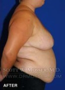 Breast Reduction Patient 24410 After Photo Thumbnail # 8