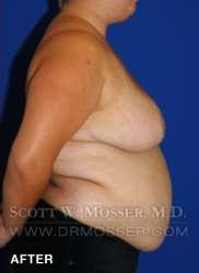 Breast Reduction Patient 24410 After Photo # 8