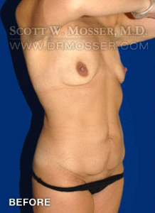 Abdominoplasty Patient 54737 Before Photo # 3