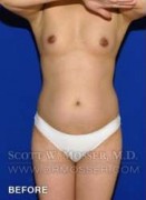 Liposuction - Abdomen & Flanks Patient 98943 Before Photo Thumbnail # 1