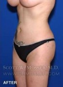 Liposuction - Abdomen & Flanks Patient 81638 After Photo Thumbnail # 6