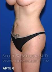 Liposuction - Abdomen & Flanks Patient 81638 After Photo # 6