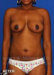 Breast Lift Without Implants Patient 55667 After Photo # 2